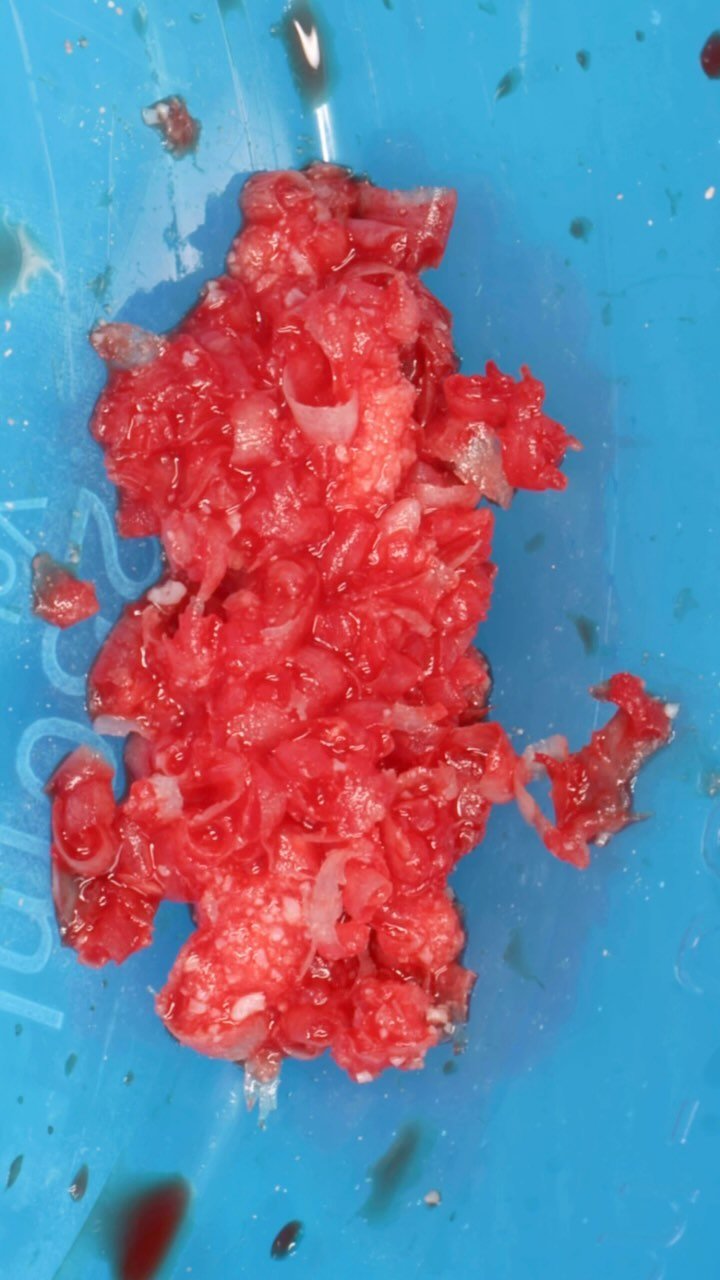 EDUCATIONAL CONTENT:
IMPLANT PLACEMENT AND HORIZONTAL BONE AUGMENTATION
Getting a lot of 36/46’s lately, probably because it’s the first permanent tooth to break through and the first one a lot of people lose🥲
Implant was placed and a
