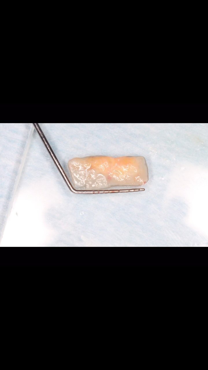 EDUCATIONAL CONTENT:
TREATMENT OF FISTULA AFTER IMPLANT PLACEMENT
12 extraction and immediate implant placement with temporary crown was done a while back
2 weeks healing was uneventful
During impression for definitive crown after 3mo, a fistula