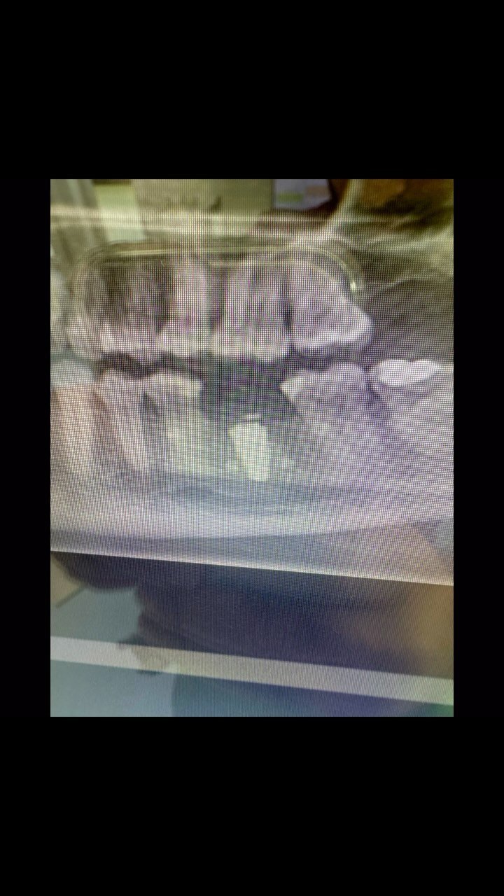 EDUCATIONAL CONTENT:
IMPLANT PLACEMENT AND HORIZONTAL BONE AUGMENTATION
Lets continue the broken ringflash series😂👇
Extraction 36 was done 3 months ago by referring dentist
Implant was placed and a few threads on the buccal were exposed
Autolo