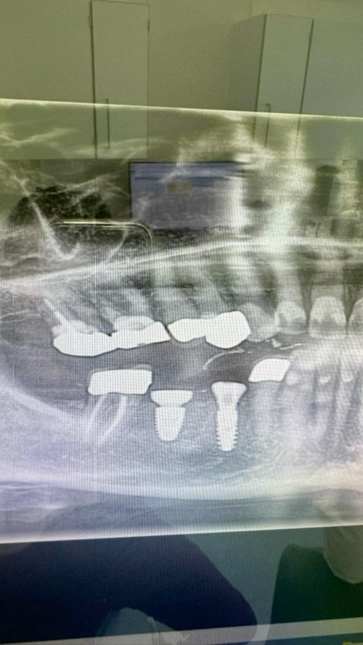 EDUCATIONAL CONTENT:
Extraction and immediate implant placement with SSA.
Implants placed with high torque ->
The socket 45 was grafted with DBBM after implant placement ->
A socket seal abutment was made to maintain the gingival architectu