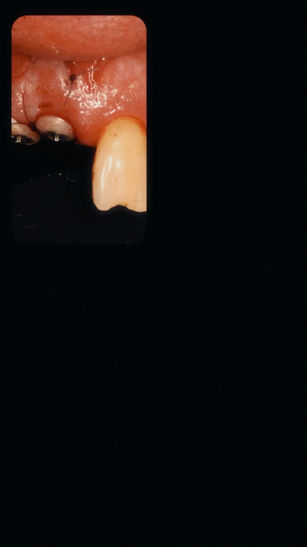 EDUCATIONAL CONTENT:
Extraction and immediate implant placement with SSA.
Implant placed with high torque ->
The socket was grafted with DBBM after implant placement ->
A connective tissue graft was harvest from the palate and tunneled into