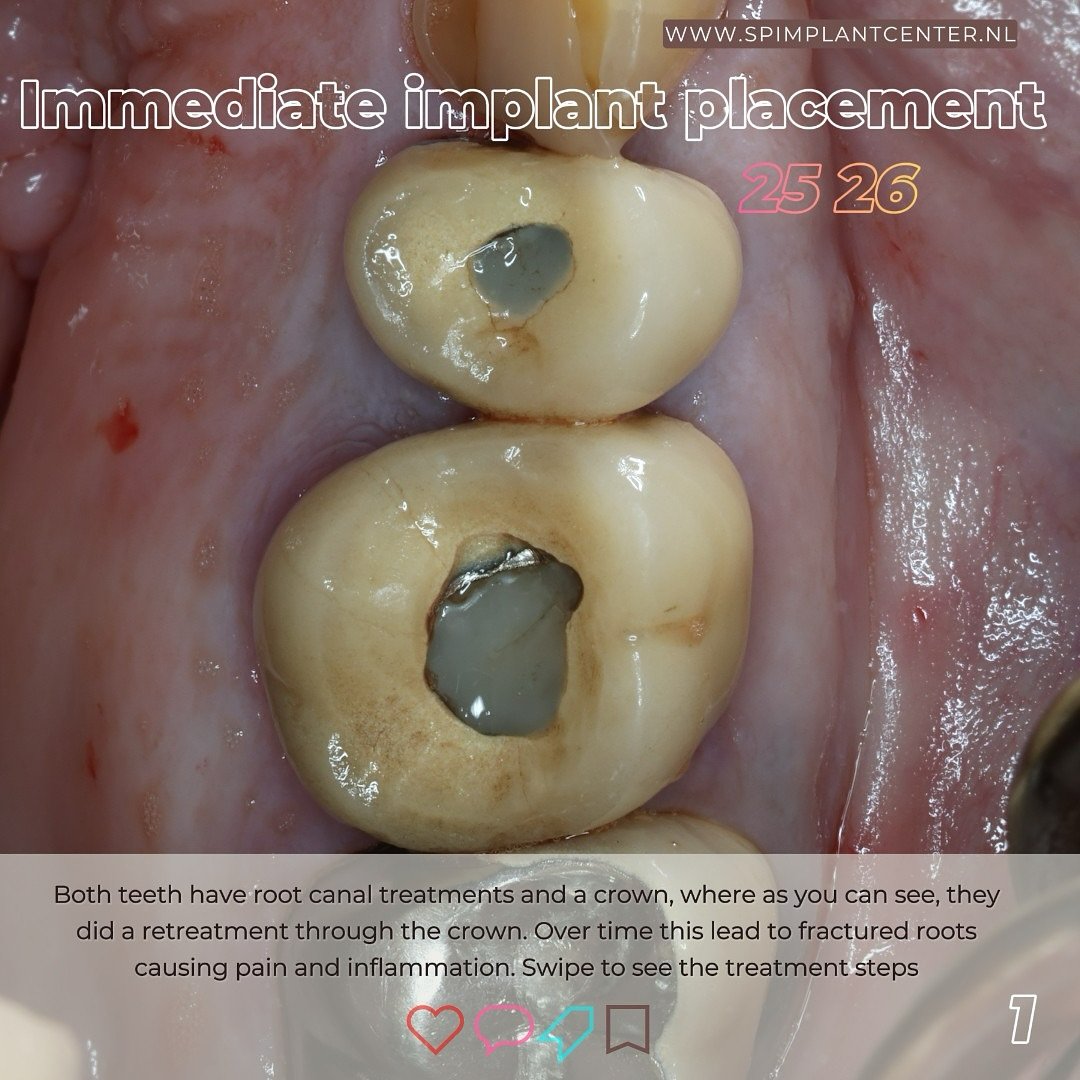 EDUCATIONAL CONTENT:
Extraction and immediate implant placement with temporary crown 25 and SSA 26
The teeth were removed as atraumatically as possible to keep bone and tissues intact🦴 Degranulation of the sockets was performed.
Implants were pla