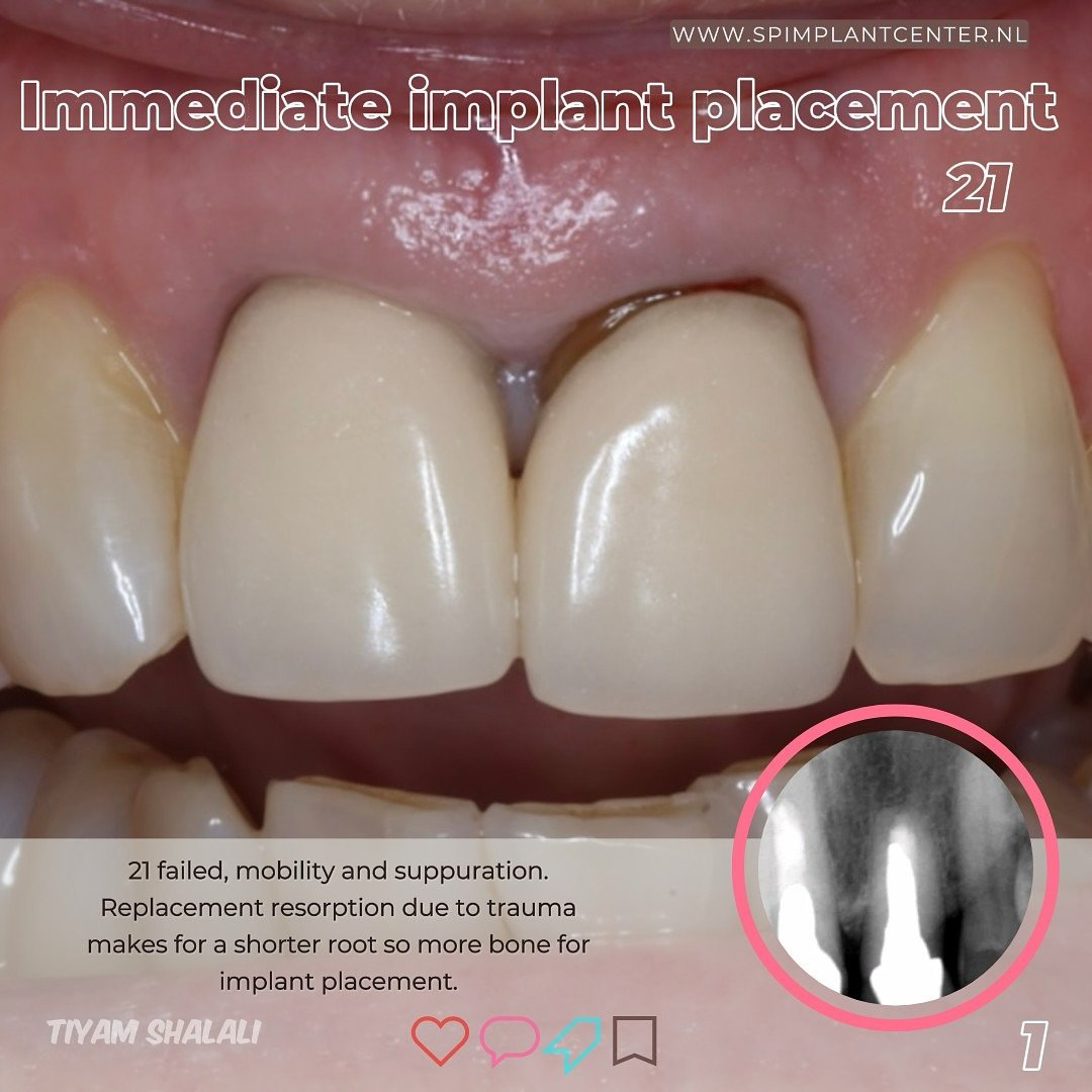 EDUCATIONAL CONTENT:
Extraction and immediate implant placement with temporary crown 21.
The tooth was removed as atraumatically as possible to keep bone and tissues intact🦴 Degranulation of the socket was performed.
Implant was placed with high