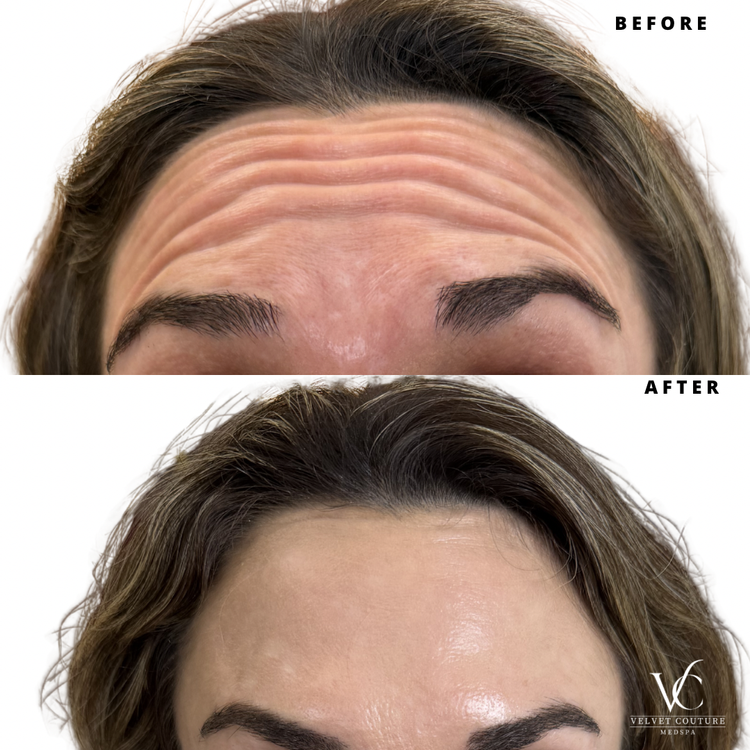 Client before and after, forehead lines. Individual results vary.