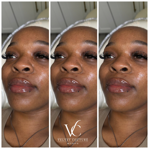 Lips, before & after, photo 17 of 26