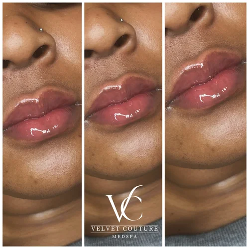Lips, before & after, photo 10 of 26