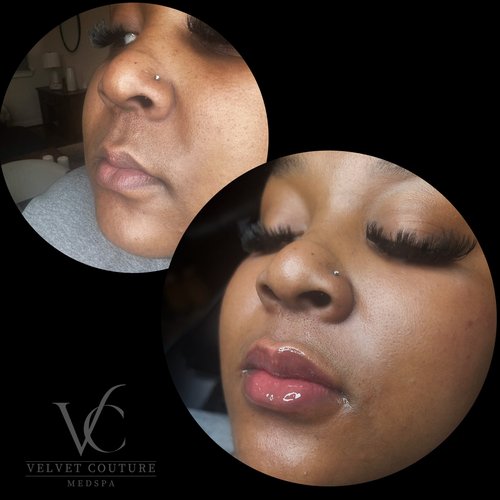 Lips, before & after, photo 18 of 26
