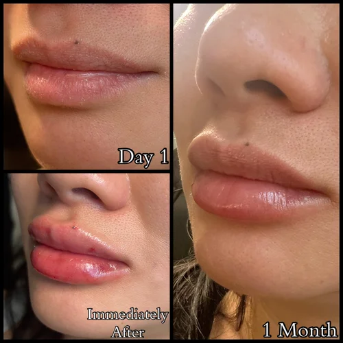Lips, before & after, photo 20 of 26