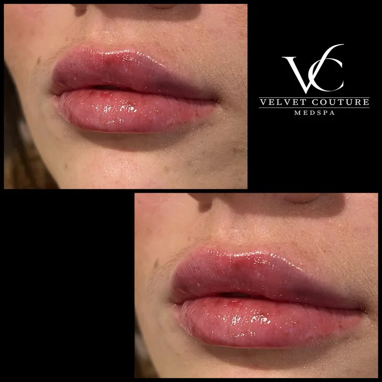 Client before and after, lips. Individual results vary.