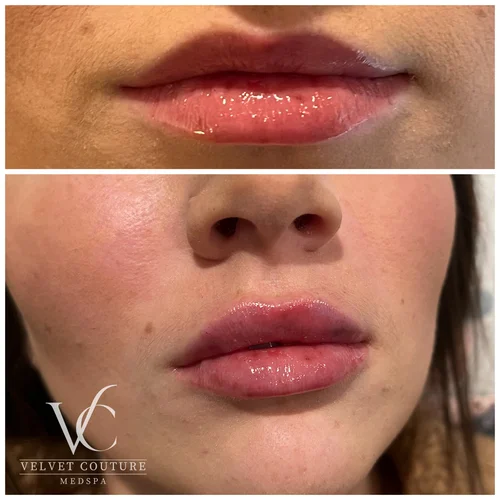 Lips, before & after, photo 5 of 26