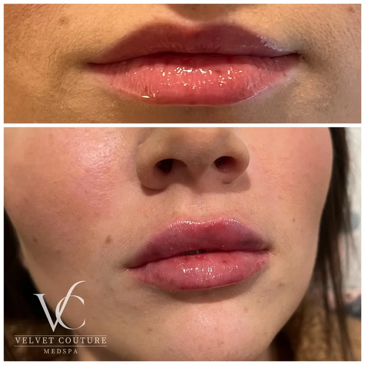 Client before and after, lips. Individual results vary.