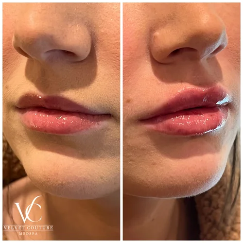 Lips, before & after, photo 4 of 26