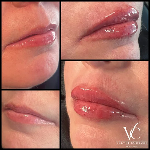 Lips, before & after, photo 19 of 26