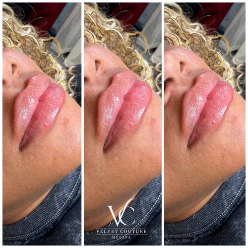 Lips, before & after, photo 13 of 26