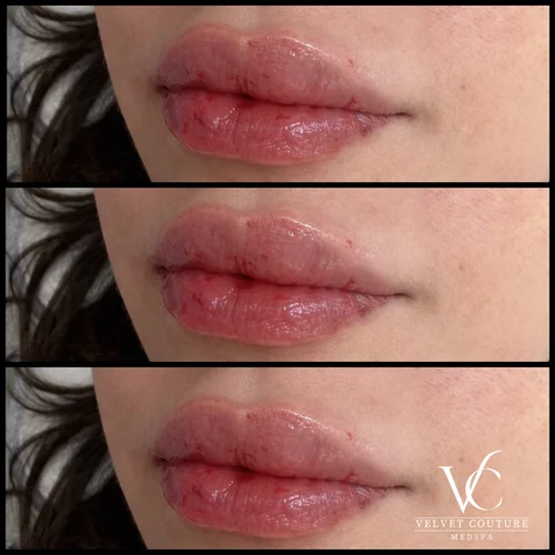 Lips, before & after, photo 9 of 26