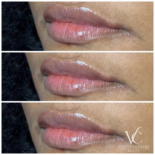 Lips, before & after, photo 11 of 26