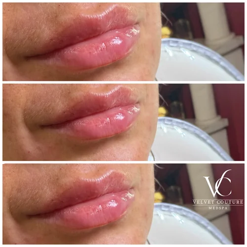 Lips, before & after, photo 2 of 26