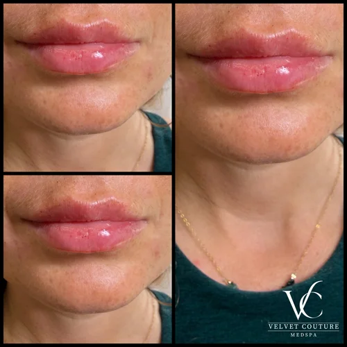 Lips, before & after, photo 1 of 26