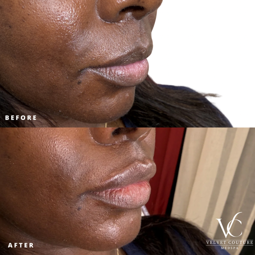 Lips, before & after, photo 23 of 26