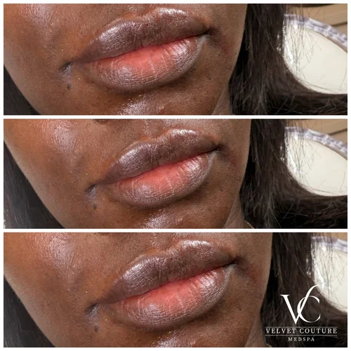 Lips, before & after, photo 7 of 26