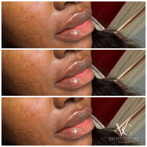 Lips, before & after, photo 8 of 26