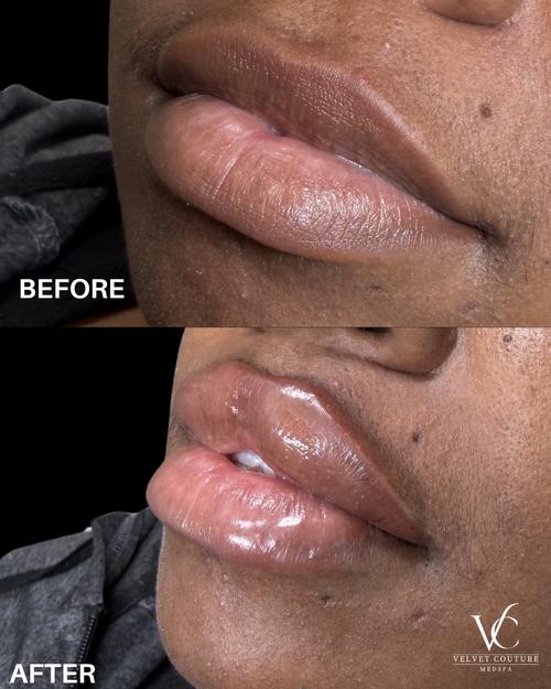 Lips, before & after, photo 6 of 26