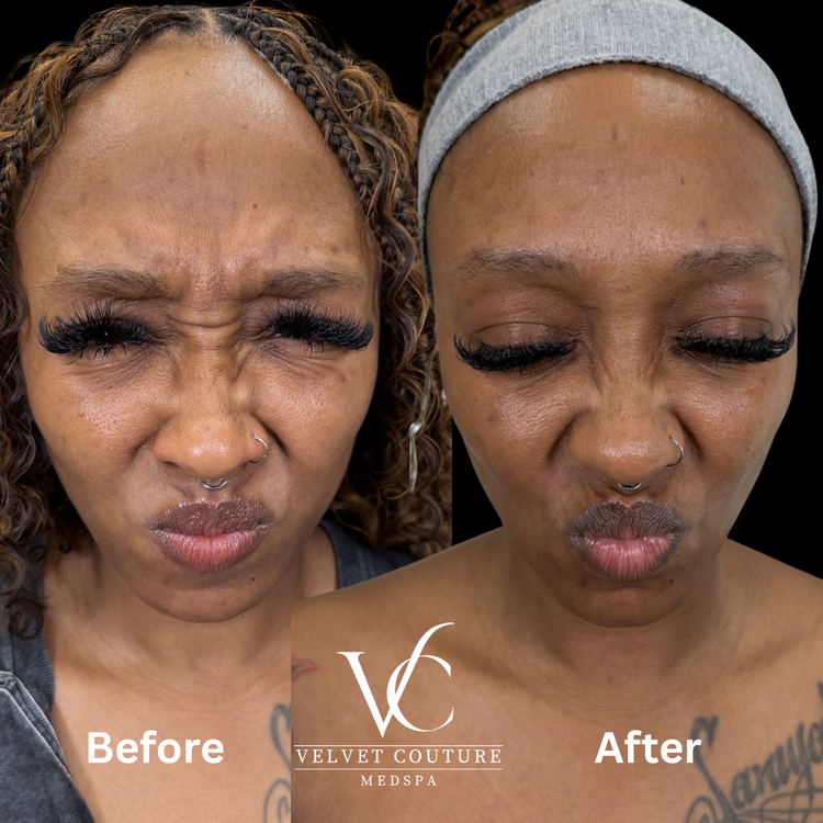 Client before and after, forehead lines. Individual results vary.