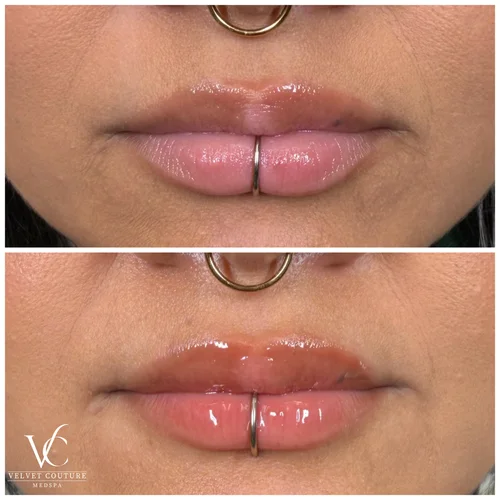 Lips, before & after, photo 15 of 26