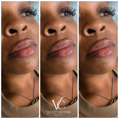 Lips, before & after, photo 14 of 26
