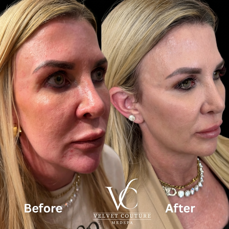 Client before and after, face. Individual results vary.