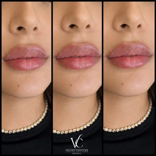 Lips, before & after, photo 12 of 26