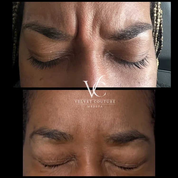 Client before and after, wrinkle relaxer