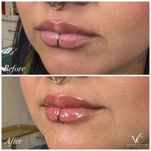 Lips, before & after, photo 16 of 26