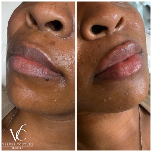 Lips, before & after, photo 25 of 26