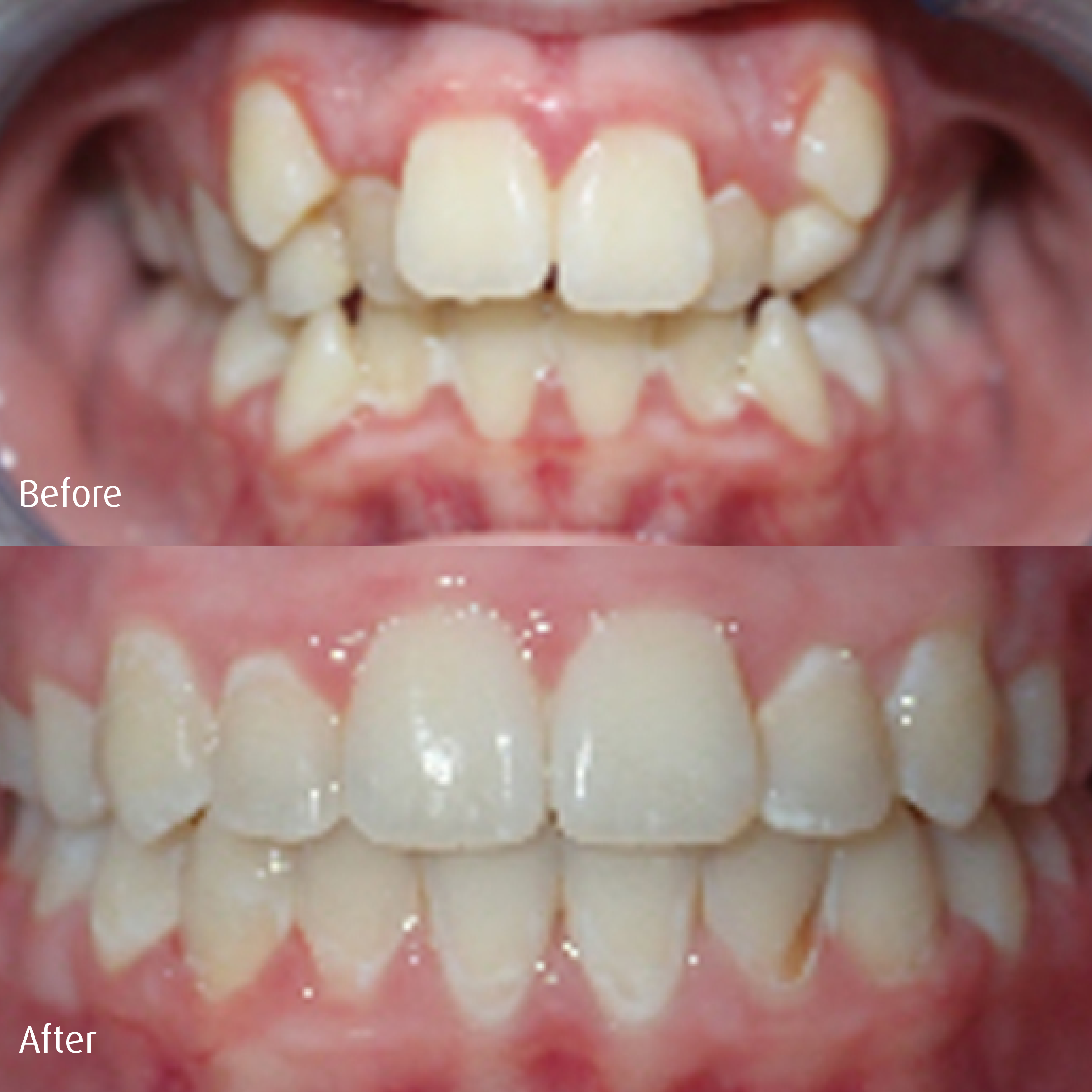 Spring-Orthodontics-Smile-Gallery-Comprehensive-Treatment3.png