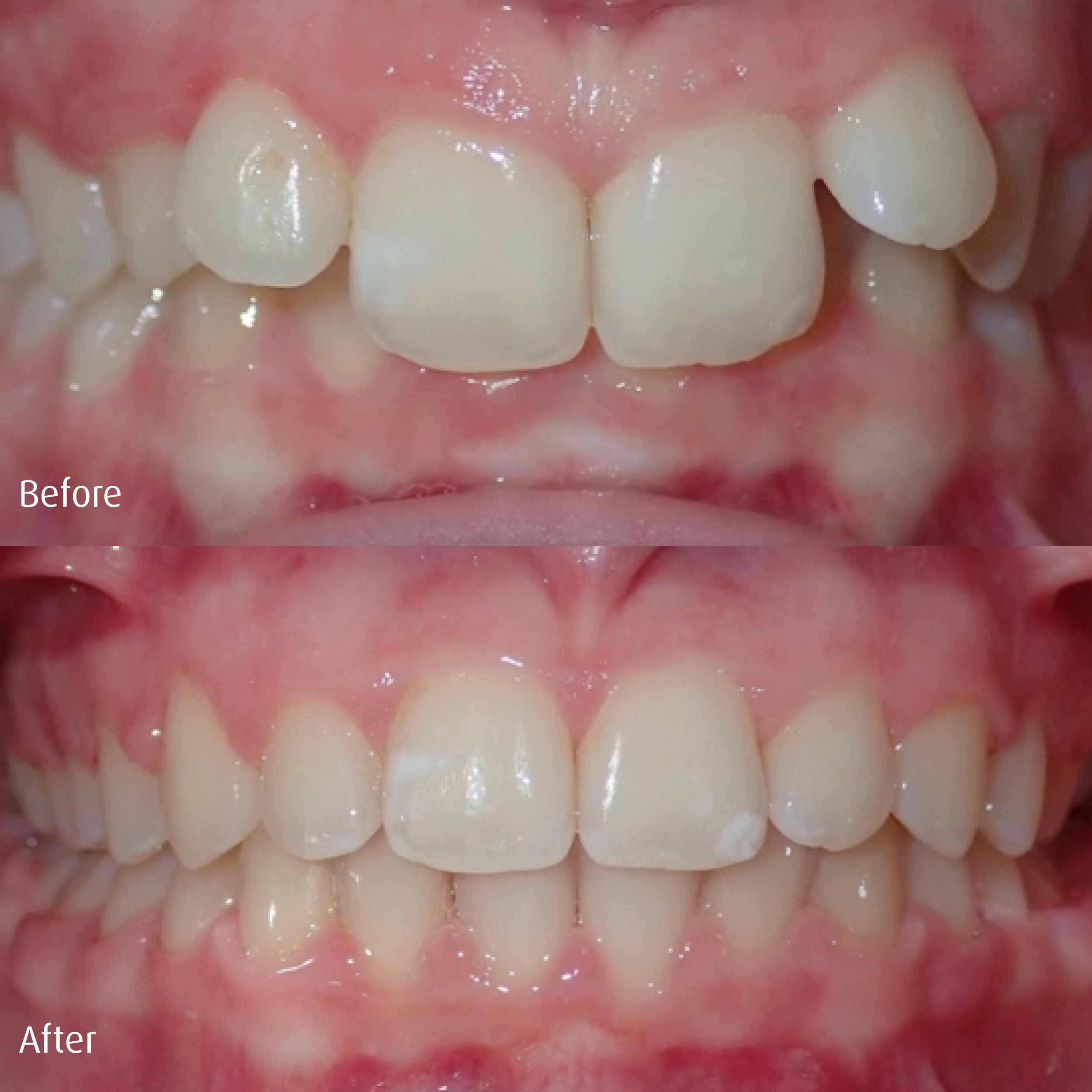 Spring-Orthodontics-Smile-Gallery-Comprehensive-Treatment.png