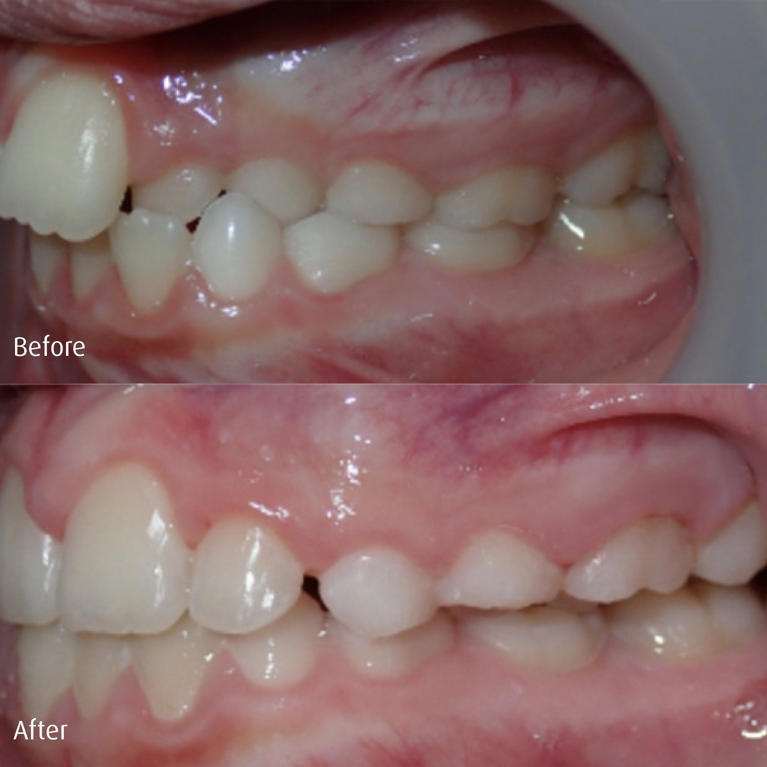 Spring-Orthodontics-Smile-Gallery-Early-Phase1-Treatment4.png