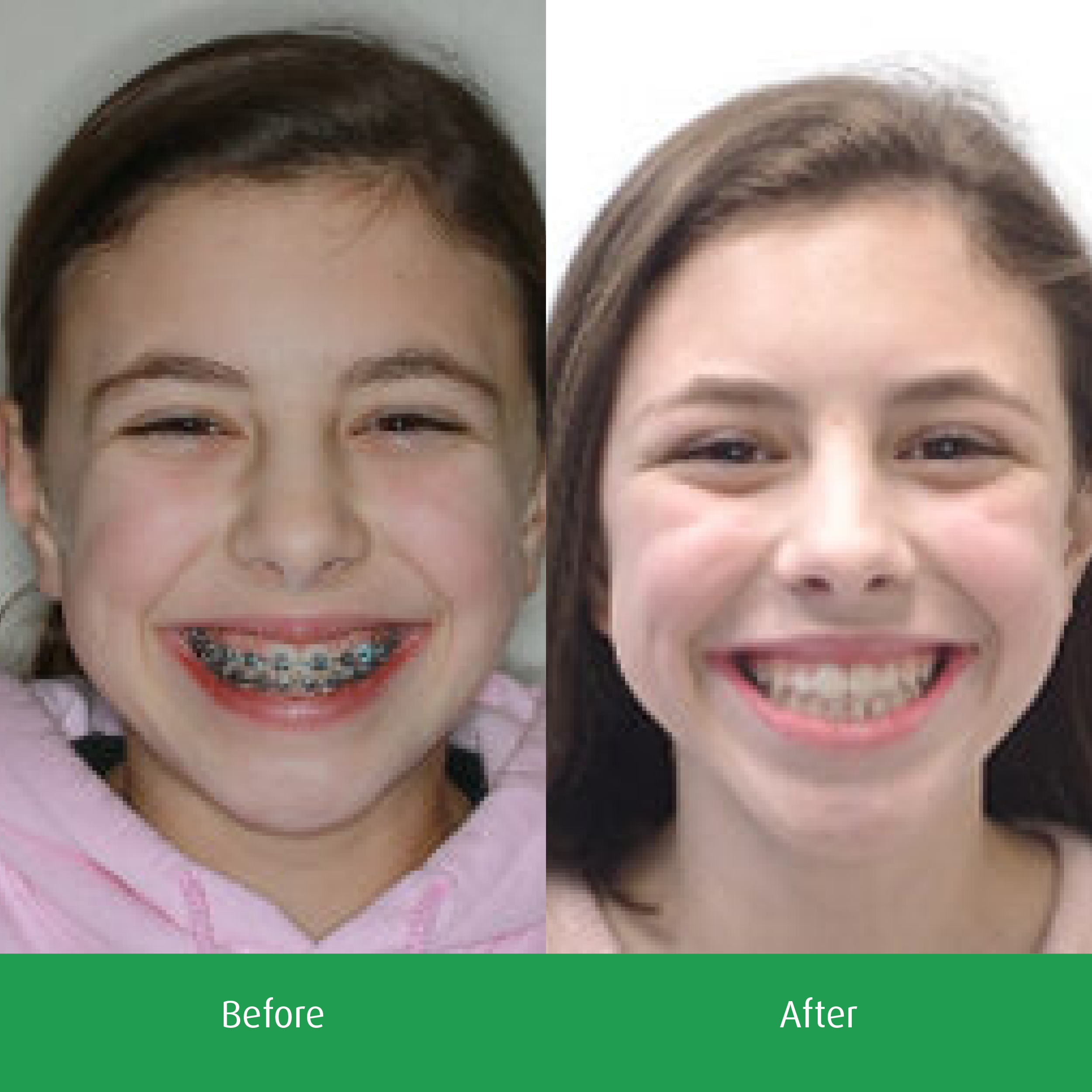 Spring-Orthodontics-Smile-Gallery-See-Our-Smiles5.png