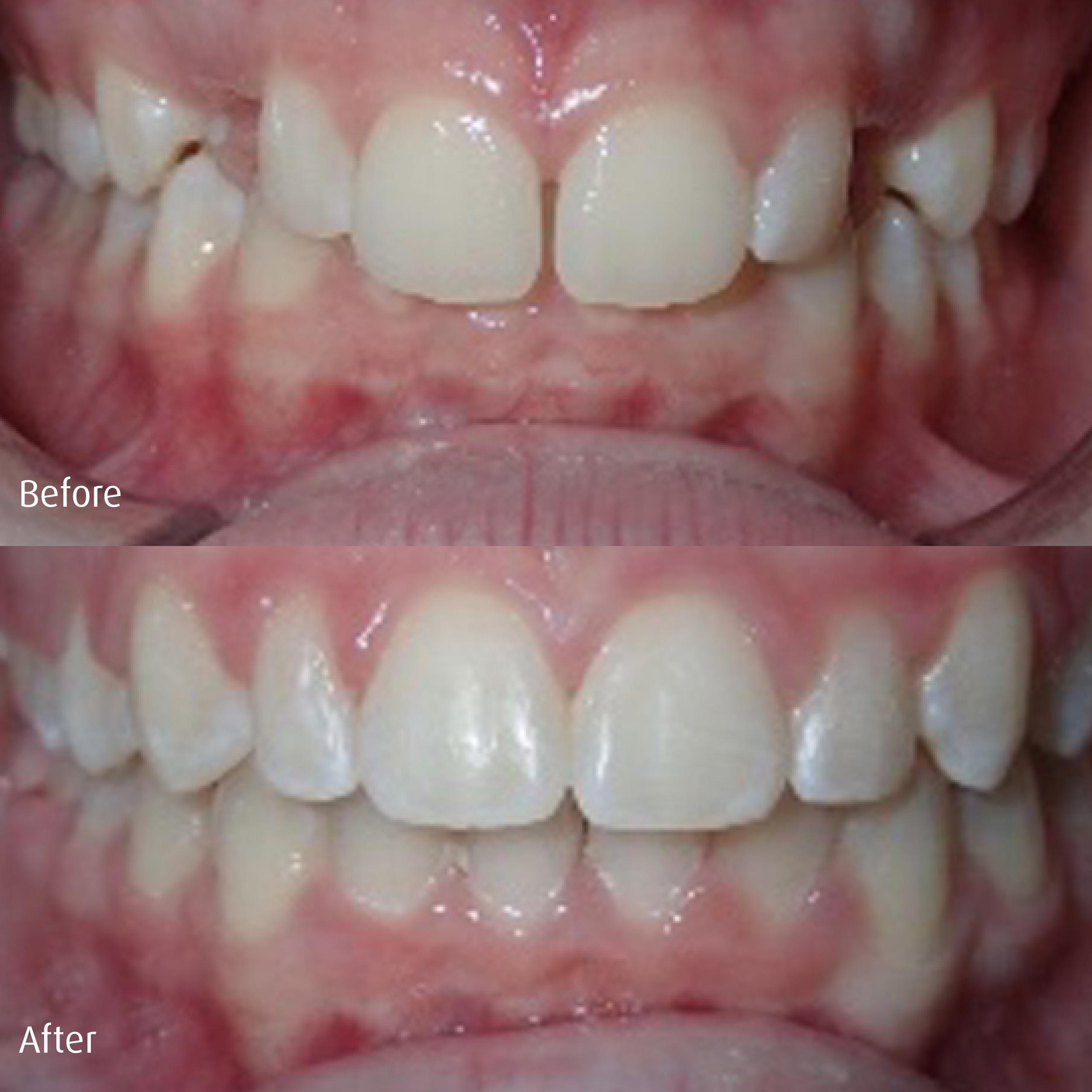 Spring-Orthodontics-Smile-Gallery-Comprehensive-Treatment5.png