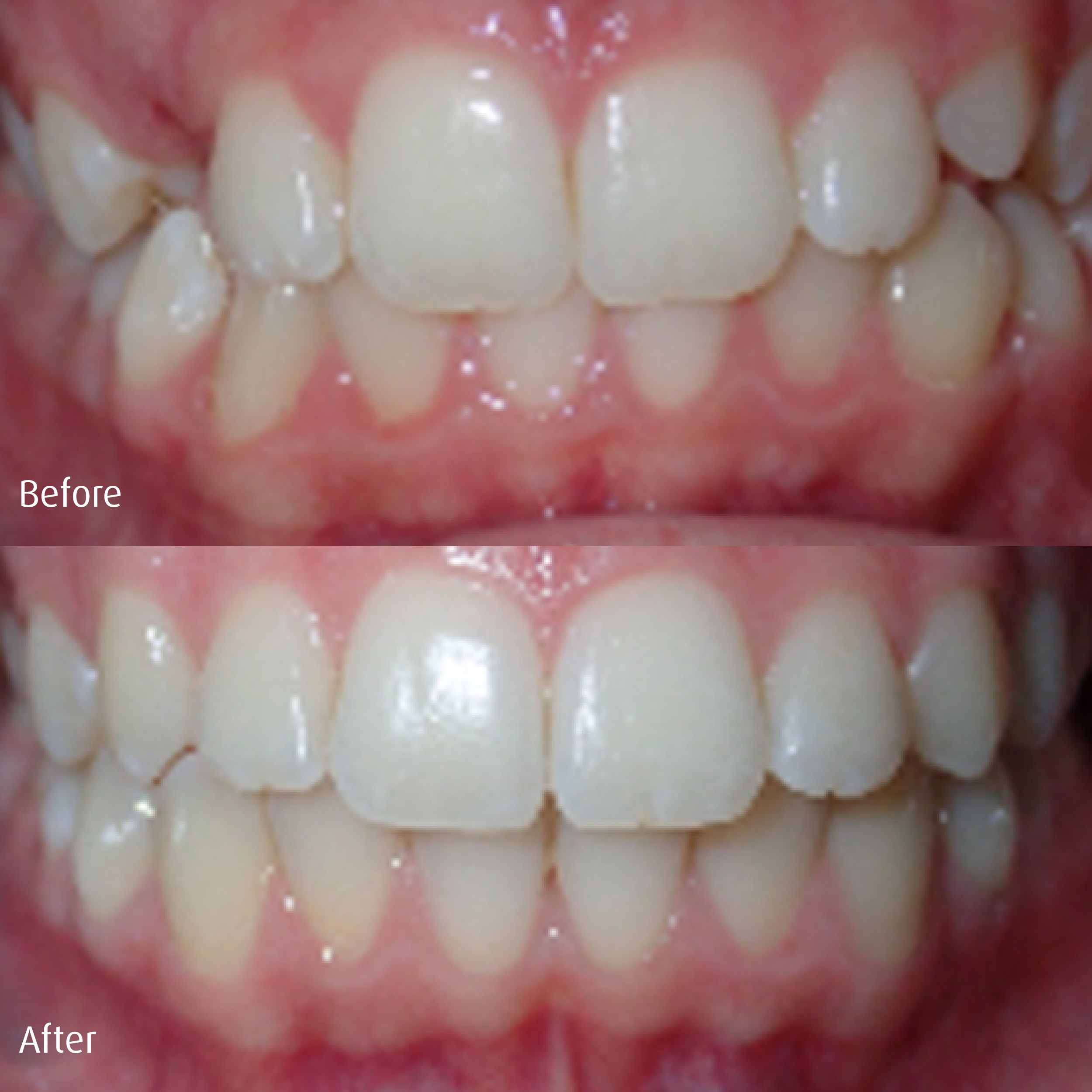 Spring-Orthodontics-Smile-Gallery-Comprehensive-Treatment4.png