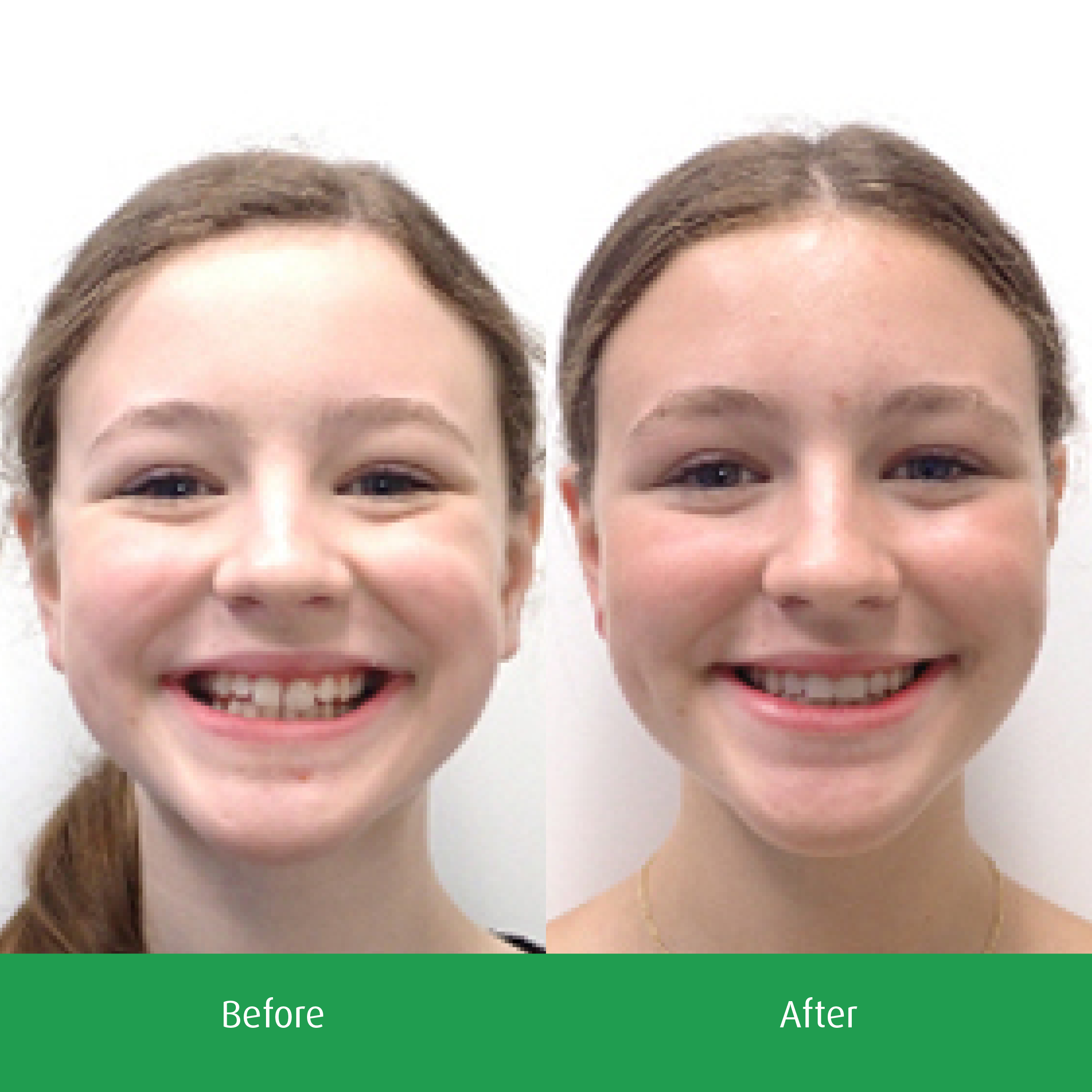 Spring-Orthodontics-Smile-Gallery-See-Our-Smiles4.png