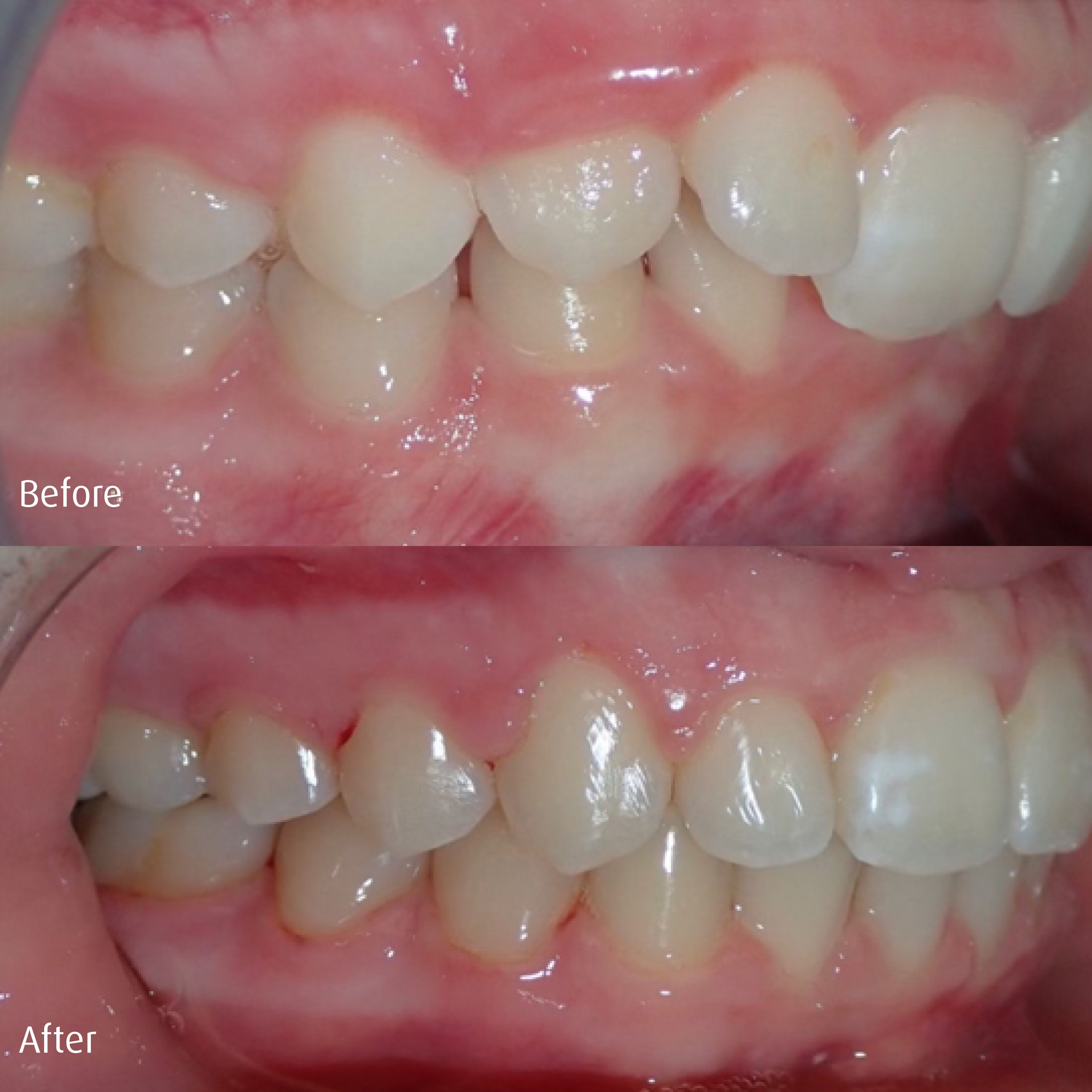 Spring-Orthodontics-Smile-Gallery-Comprehensive-Treatment2.png