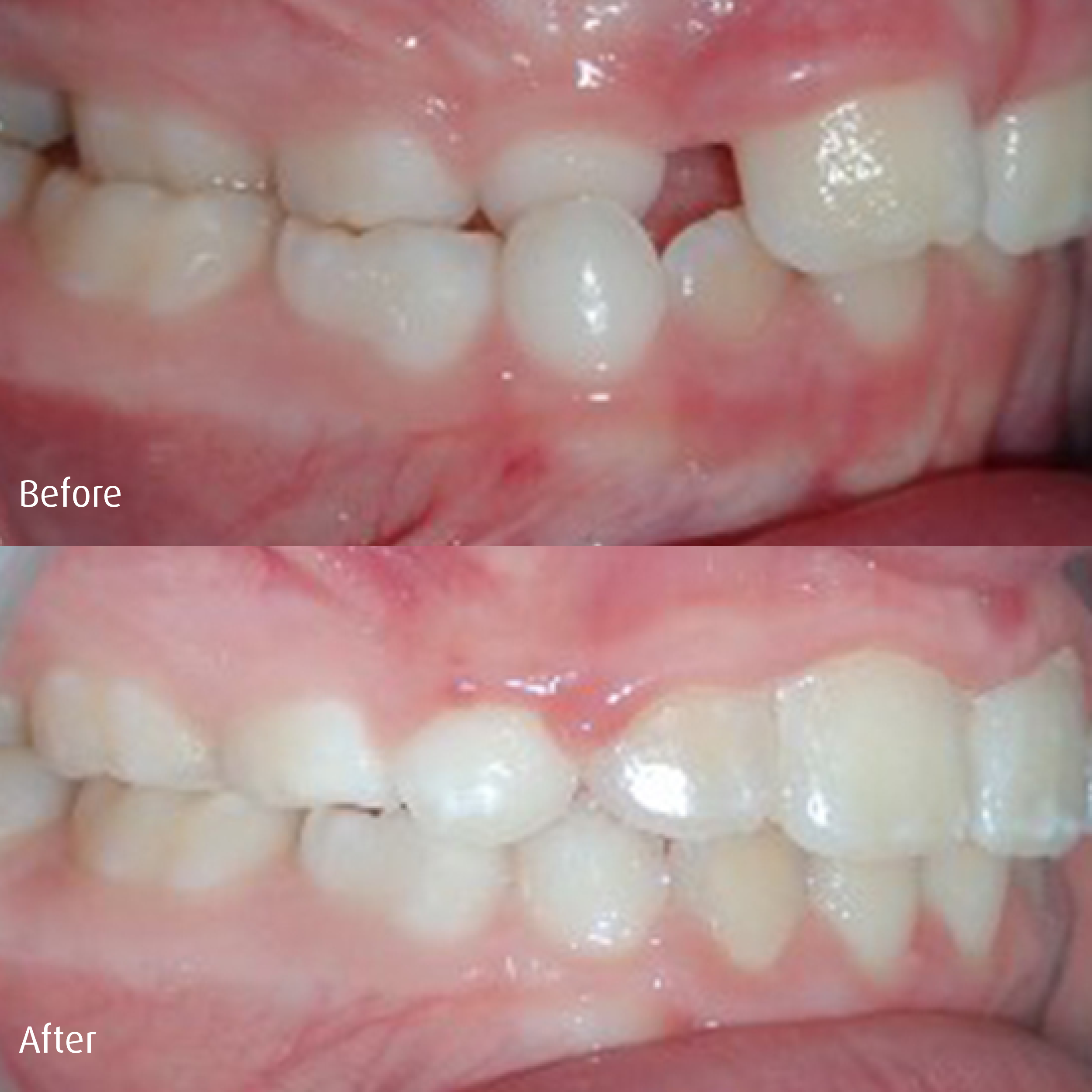 Spring-Orthodontics-Smile-Gallery-Early-Phase1-Treatment.png