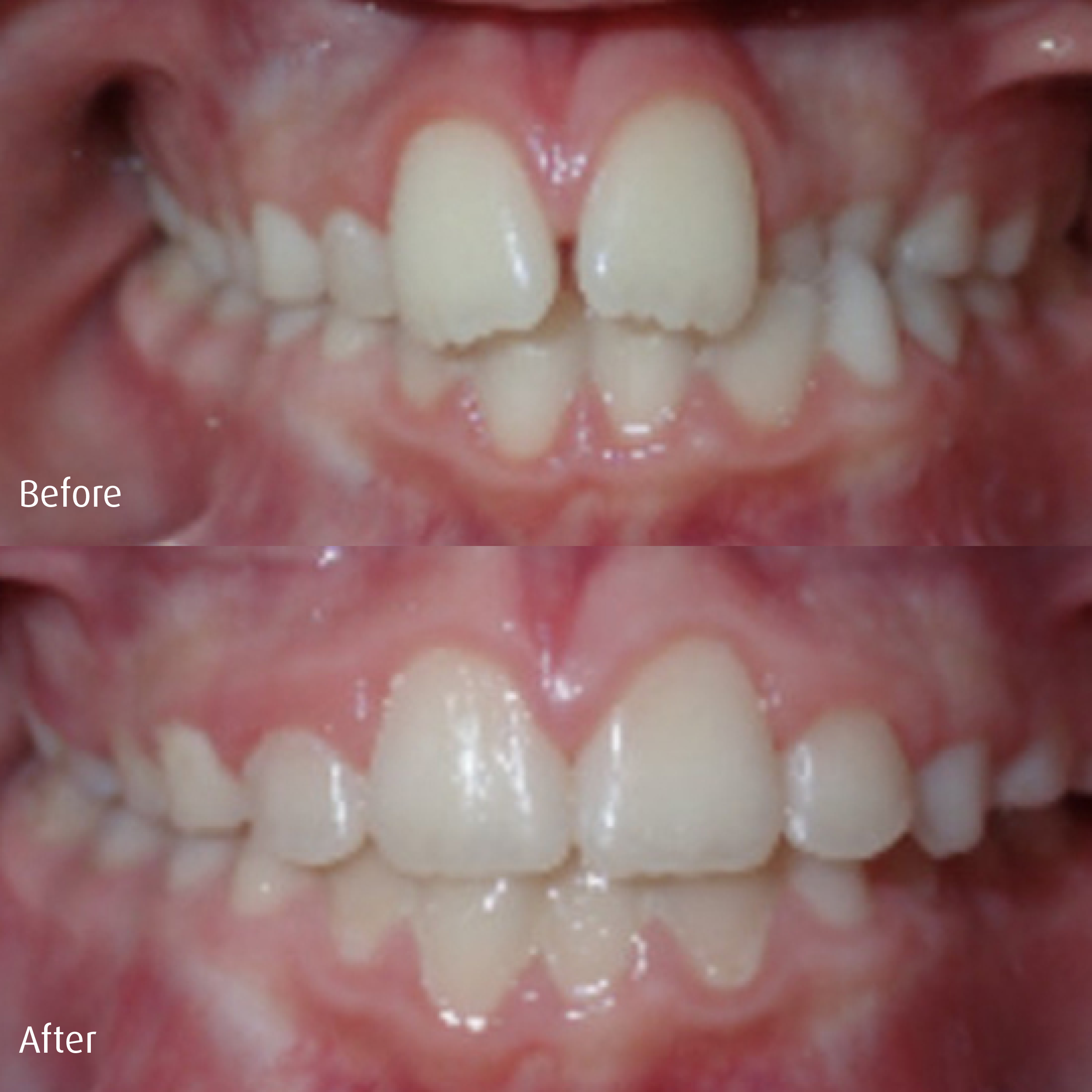 Spring-Orthodontics-Smile-Gallery-Early-Phase1-Treatment5.png