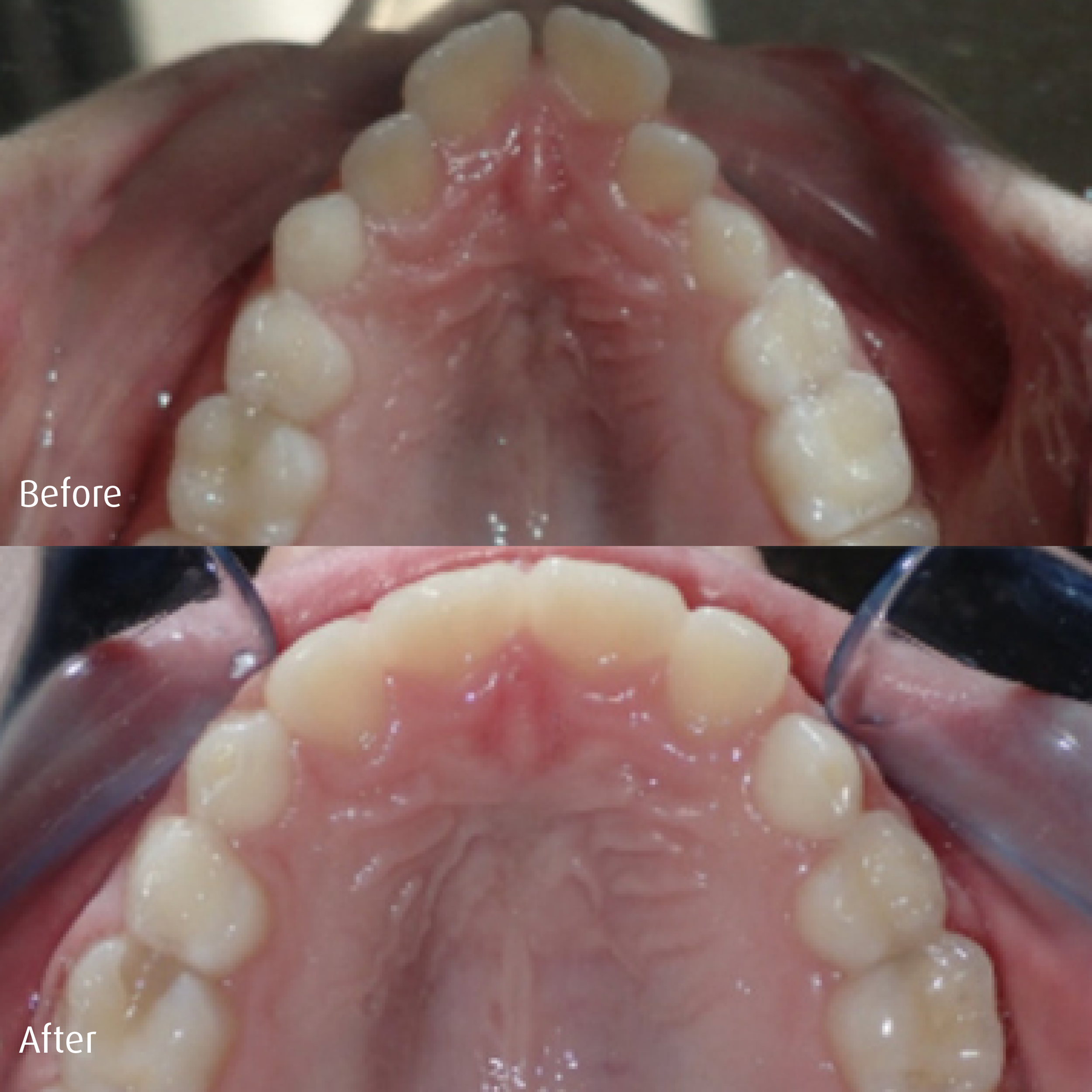 Spring-Orthodontics-Smile-Gallery-Early-Phase1-Treatment3.png