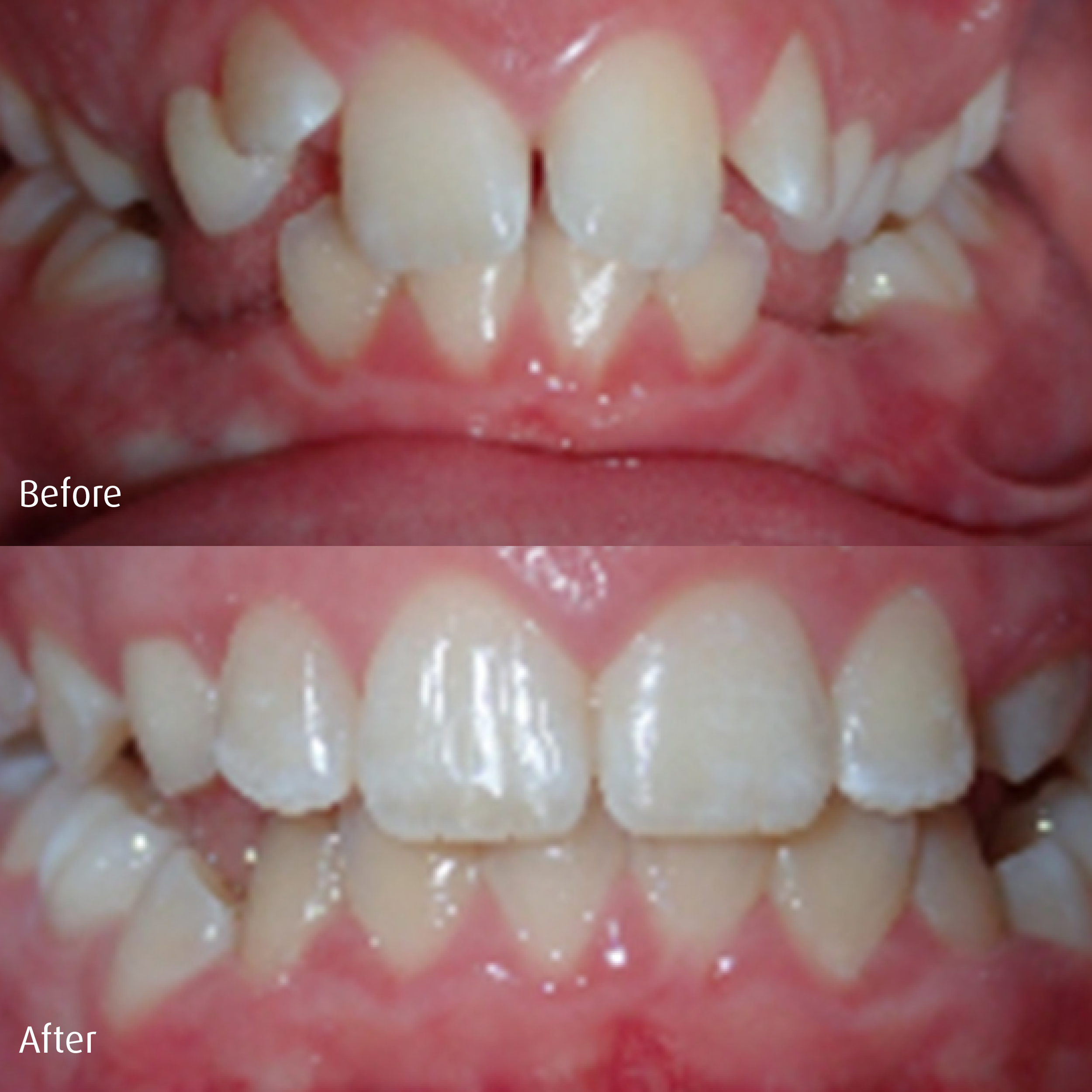 Spring-Orthodontics-Smile-Gallery-Early-Phase1-Treatment2.png