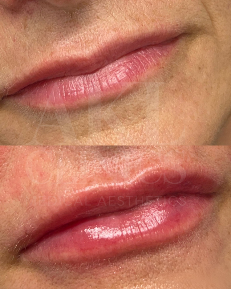 Lip filler before and after - natural results