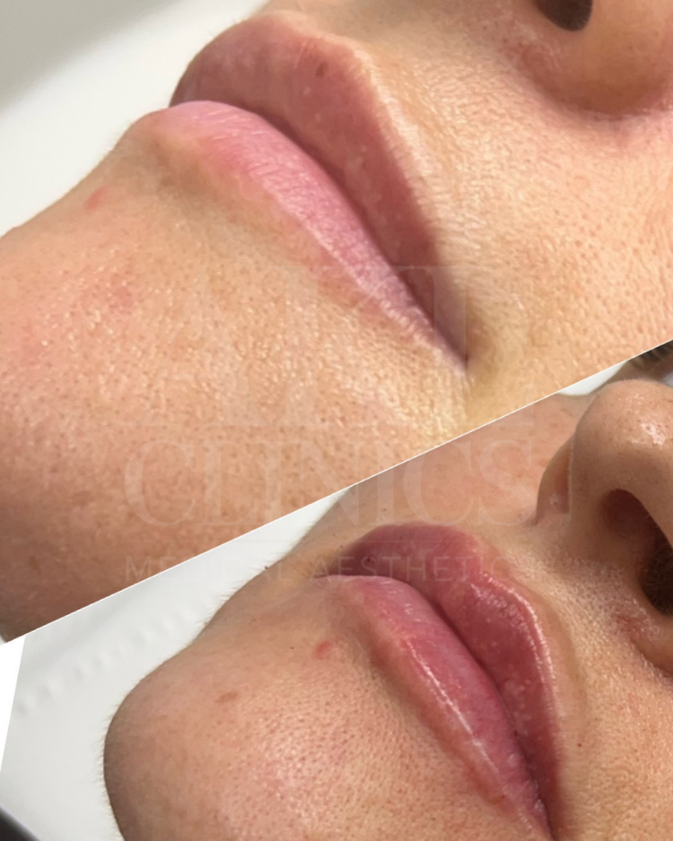 Lip filler before and after - subtle volume