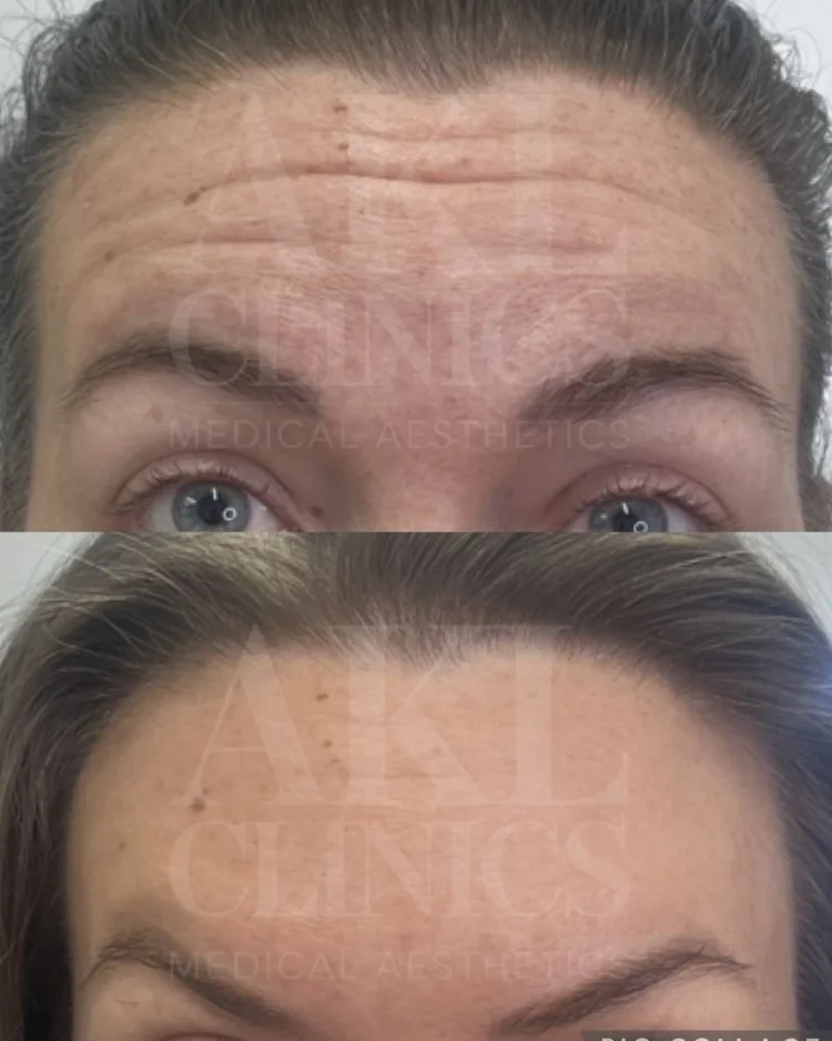 Anti-wrinkle results - frown lines