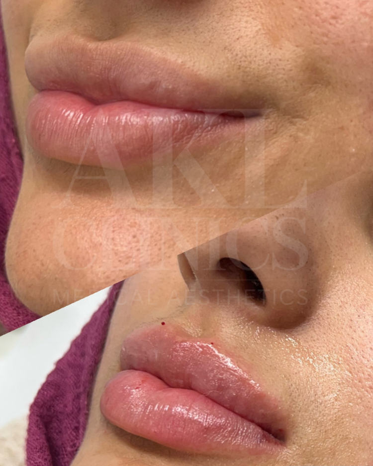 Lip filler before and after - shape and definition